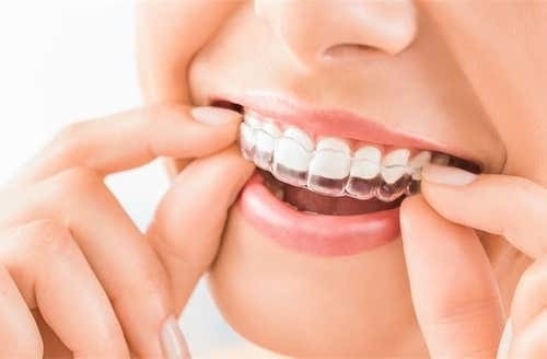 คอร์สจัดฟันแบบใส Invisalign Full Comprehensive ฟันบนและล่าง ที่ Bangkok Smile Dental