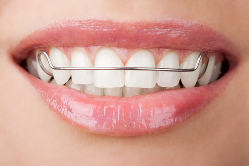 ทำรีเทนเนอร์แบบโลหะ 2 ชิ้น ฟันบนและล่าง ที่ Deezy Dental Home
