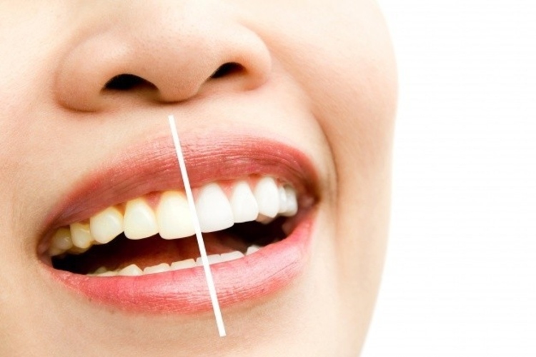 ชุดฟอกสีฟันที่บ้าน ที่ Smile Plus Dental Clinic (เพชรบูรณ์)