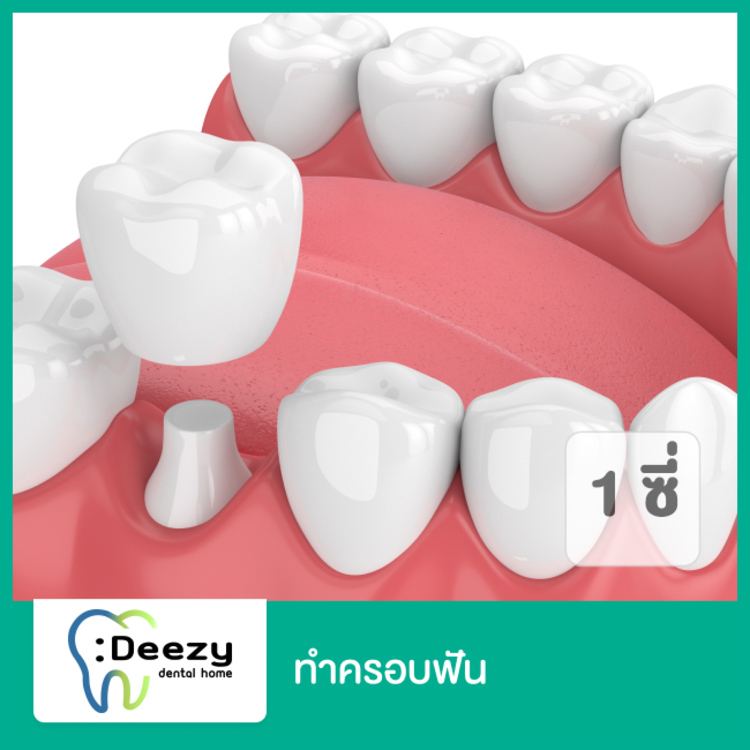 ทำครอบฟัน 1 ซี่ (เริ่มต้นที่ 7000 บาท ตามแพทย์ประเมิน) ที่ Deezy Dental Home