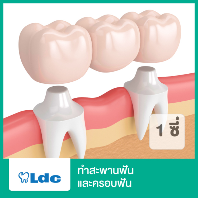 ทำสะพานฟันและครอบฟัน 1 ซี่ ที่ LDC Dental