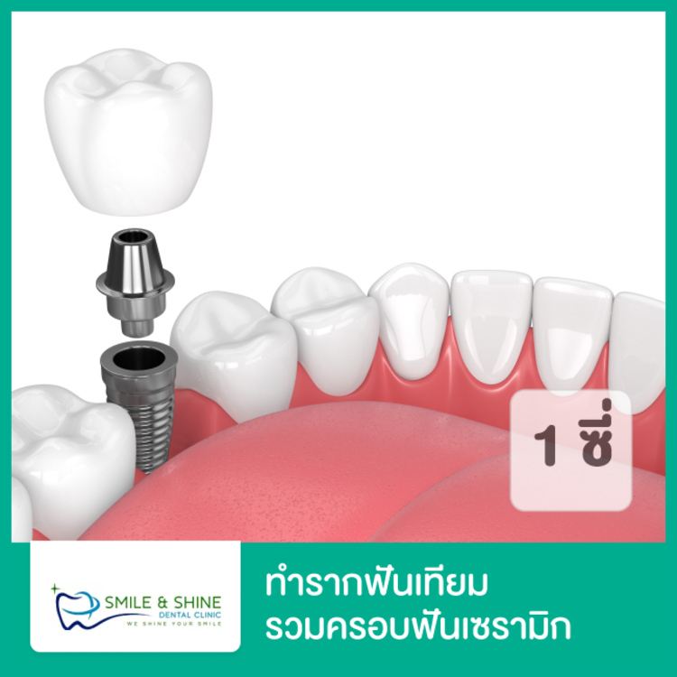 รากฟันเทียมยี่ห้อ Dentium หรือ Osstem รวมครอบฟันเซรามิกล้วนหนึ่งซี่ ที่ Smile & Shine Dental (คลินิกทันตกรรมสไมล์แอนด์ชายน์)