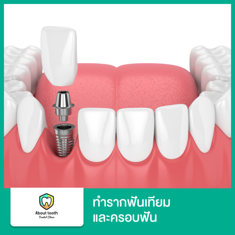 ทำรากฟันเทียมและครอบฟัน ที่ About Tooth Dental Clinic