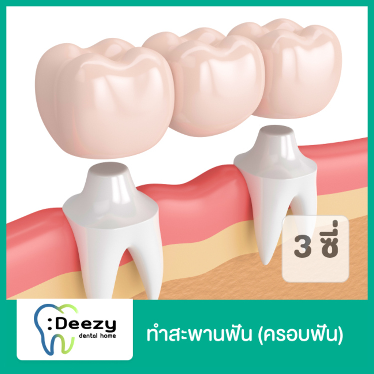 ทำสะพานฟัน (ครอบฟัน 3 ซี่) ที่ Deezy Dental Home