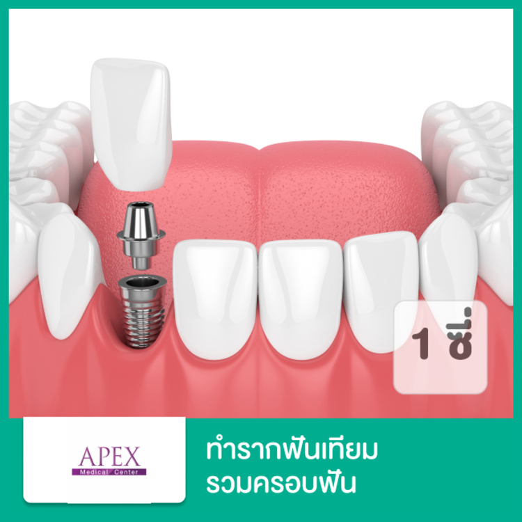 ทำรากฟันเทียม ยี่ห้อ Straumann Noble Biocare หรือ AstraTech (ตามแพทย์ประเมิน) รวมครอบฟัน 1 ซี่ ที่ APEX Medical Center