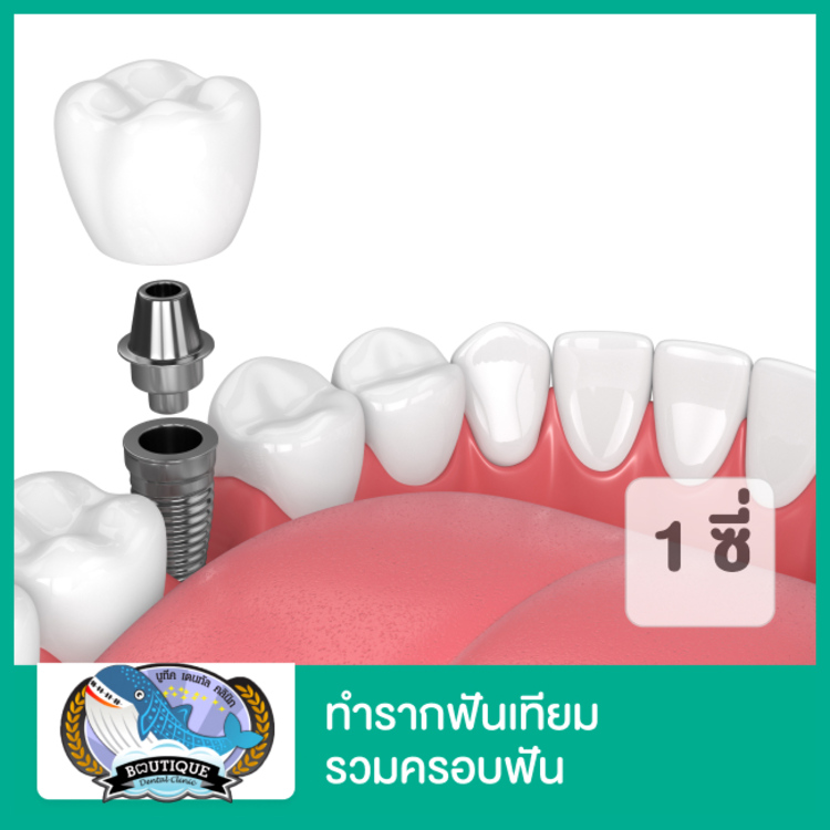 ทำรากฟันเทียม รวมครอบฟัน 1 ซี่ (ตามแพทย์ประเมิน) ที่ ศูนย์จัดฟัน รากเทียม บูทีคเด็นทัล