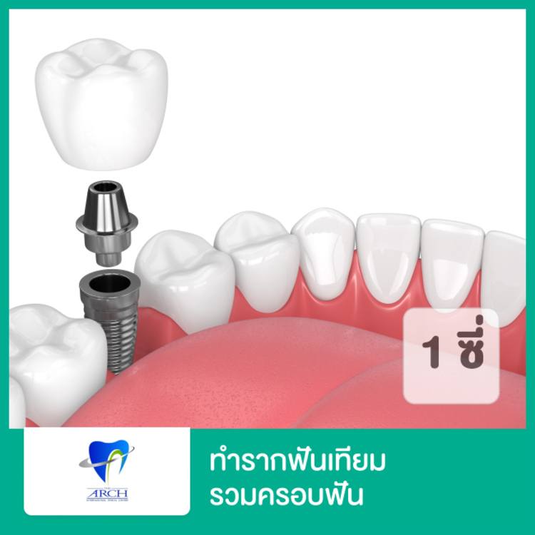 รากฟันเทียม ยี่ห้อ Straumann รวมครอบฟัน 1 ซี่ (ตามแพทย์ประเมิน) ที่ The ARCH Dental Center (ศูนย์ทันตกรรมดิอาร์ช)