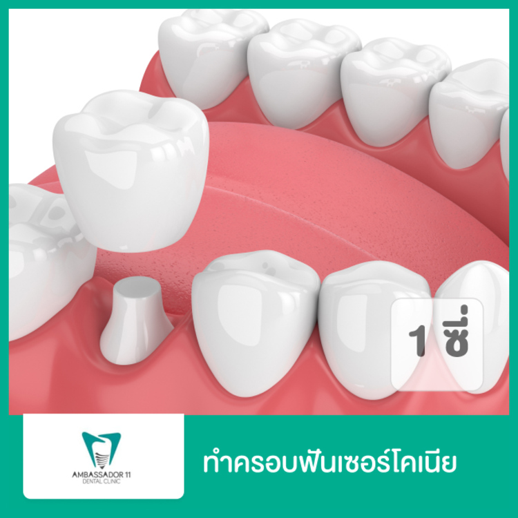 ทำครอบฟันเซอร์โคเนีย (Zirconia) 1 ซี่ (ตามแพทย์ประเมิน) ที่ Ambassador 11 Dental Clinic