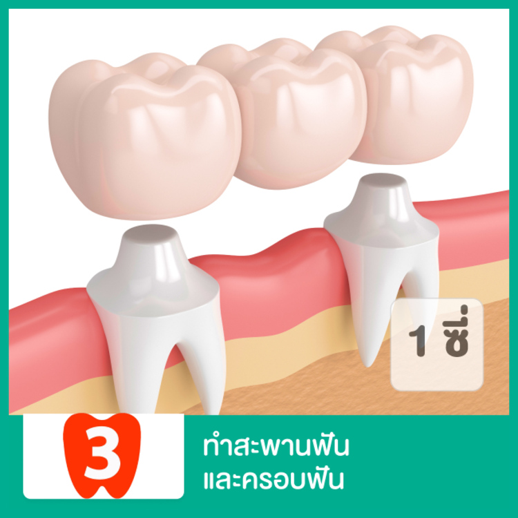 ทำสะพานฟันและครอบฟัน 1 ซี่ ที่ 3D Dental Clinic
