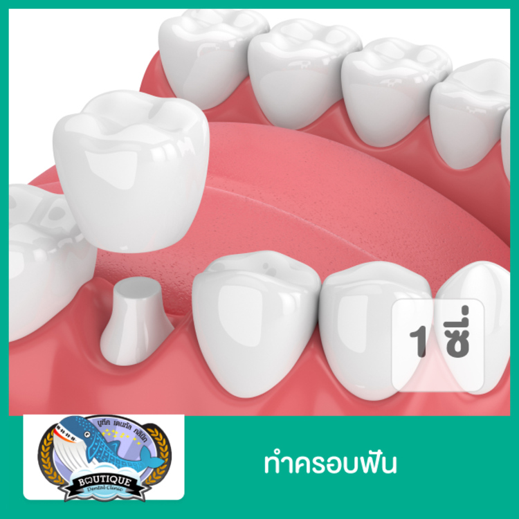 ทำครอบฟัน 1 ซี่ ที่ ศูนย์จัดฟัน รากเทียม บูทีคเด็นทัล