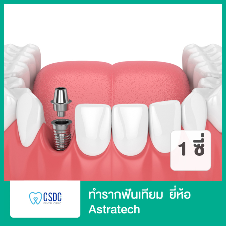 ทำรากฟันเทียม ยี่ห้อ Astra Tech 1 ซี่ ที่ CSDC