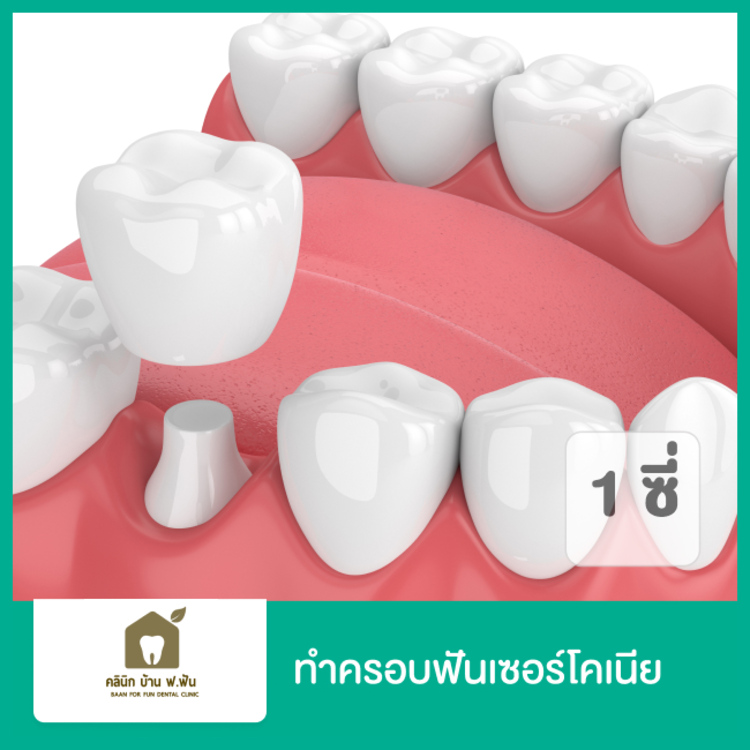 ทำครอบฟันเซอร์โคเนีย (Zirconia) 1 ซี่ ที่ บ้าน ฟ. ฟัน คลินิกทันตกรรม (Baanforfun Dentistry)