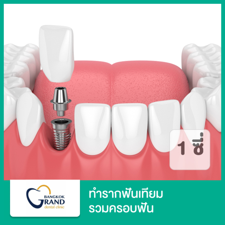 ทำรากฟันเทียม ยี่ห้อ Thai Implant รวมครอบฟัน 1 ซี่ ที่ Bangkok Grand Dental