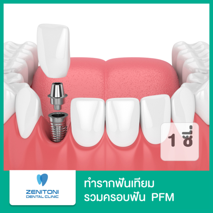ทำรากฟันเทียม รวมครอบฟัน PFM 1 ซี่ ที่ Zenitoni Dental Clinic