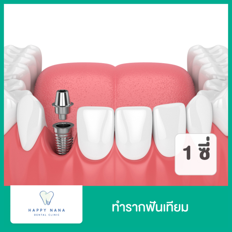 ทำรากฟันเทียม 1 ซี่ ที่ Happy Nana