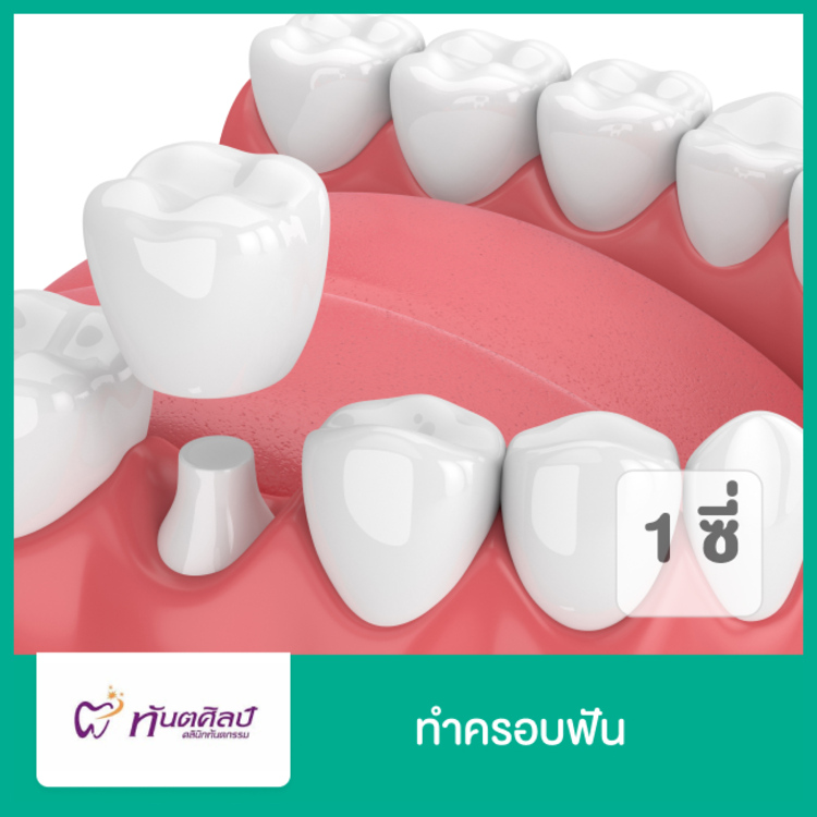 ทำครอบฟัน ที่ ทันตศิลป์ คลินิกทันตกรรม (Thantasilp Dental Clinic)