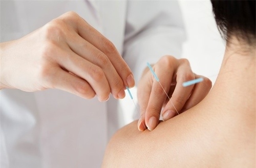 ฝังเข็มรักษาไมเกรน 1 ครั้ง (TCM Treatment) ที่ ดวงกมลคลินิกกายภาพบำบัด และการแพทย์แผนจีน