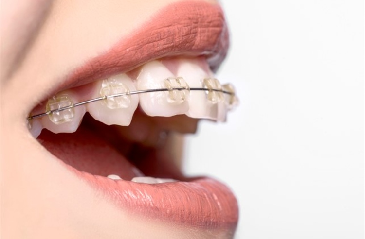จัดฟันแบบโลหะ กรณีไม่ถอนฟัน ที่ BFC Dental (บ้านฟันสวย)