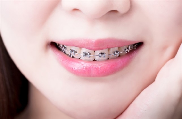 จัดฟันแบบโลหะ กรณีต้องถอนฟัน ที่ BFC Dental (บ้านฟันสวย)