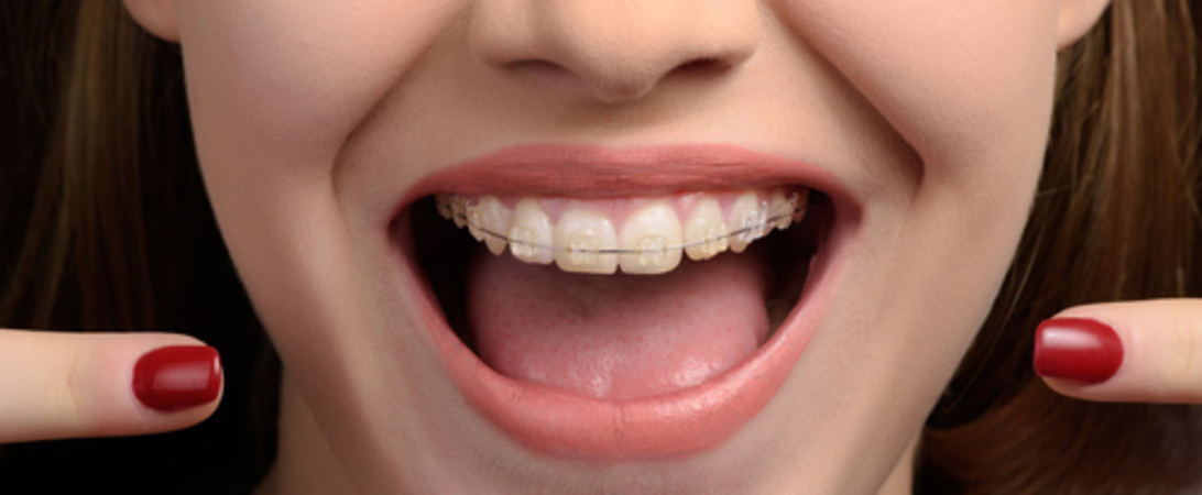จัดฟันแบบโลหะ ที่ บ้าน ฟ. ฟัน คลินิกทันตกรรม (Baanforfun Dentistry)