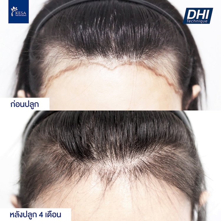 ปลูกผม ด้วยเทคนิค DHI 2,000-3,000 กราฟต์ พร้อมแพ็กเกจบำรุงและดูแลผม 8 รายการ ที่ Kesa Hair Solution & Aesthetic