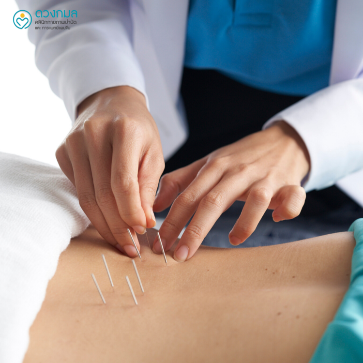 ฝังเข็มบรรเทาอาการนอนไม่หลับ 1 ครั้ง (TCM Treatment) ที่ ดวงกมลคลินิกกายภาพบำบัด และการแพทย์แผนจีน
