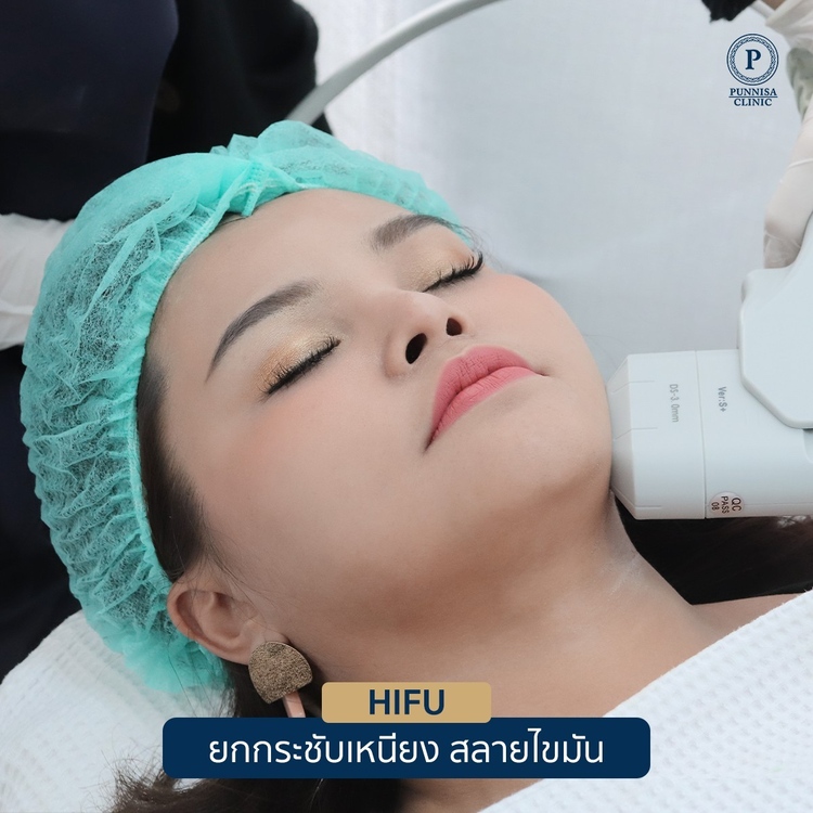 ทำ HIFU VNC Ultra Smas HIFU ไม่จำกัดช็อต บริเวณใบหน้า 1 ครั้ง ที่ Punnisa Clinic (ปันนิสาคลินิก)