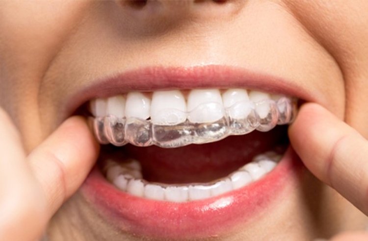 คอร์สจัดฟันแบบใส Invisalign Lite ฟันบนและล่าง ที่ The Crystal Dental Clinic