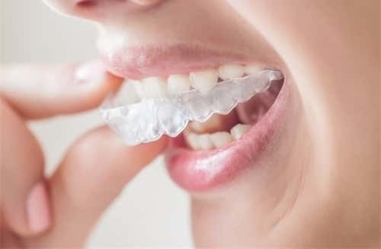 คอร์สจัดฟันแบบใส Invisalign Full Comprehensive ฟันบนและล่าง ที่ Zense Smile