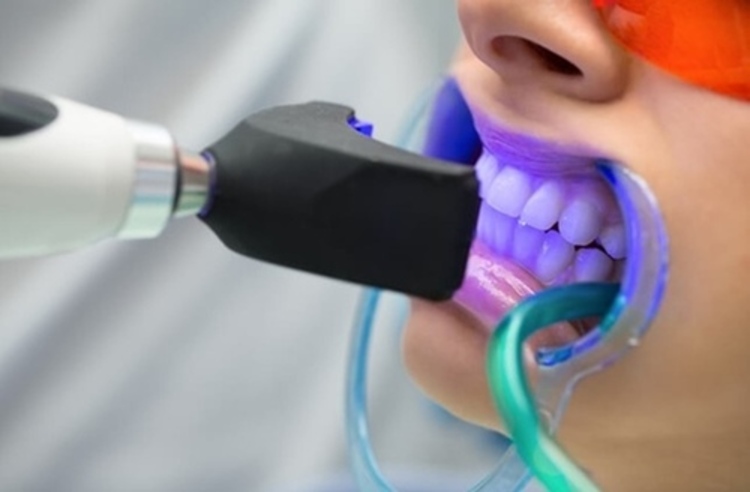 ฟอกสีฟัน ด้วยระบบ Cool Light ที่ Ivory House Dental Clinic