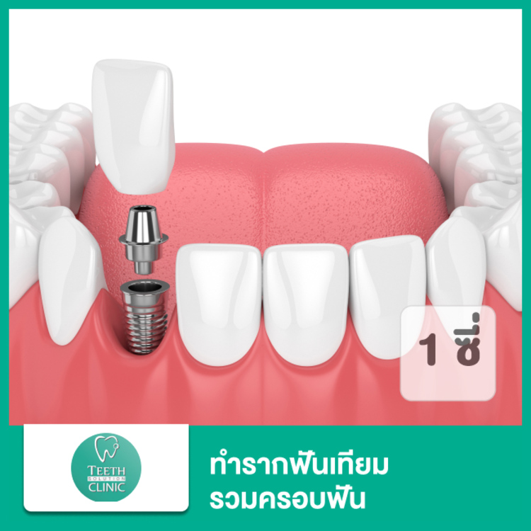 ทำรากฟันเทียม ยี่ห้อ Osstem หรือ Neobiotech พร้อมครอบฟัน 1 ซี่ (ตามแพทย์ประเมิน) ที่ Teeth Solution Clinic