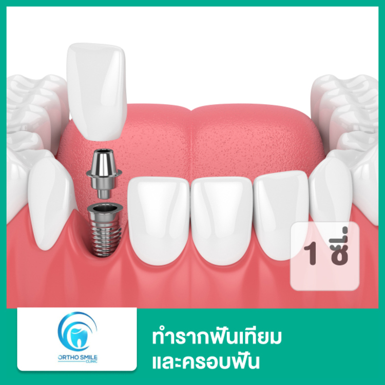 ทำรากฟันเทียม ยี่ห้อ SIC รวมครอบฟัน 1 ซี่ ที่ ออร์โธ สไมล์ ออร์โธ สไมล์