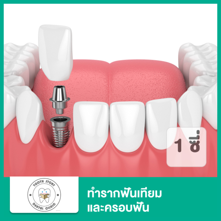 ทำรากฟันเทียม ยี่ห้อ Neobiotech รวมครอบฟัน 1 ซี่ ที่ Tooth Story DC: The Paseo Park