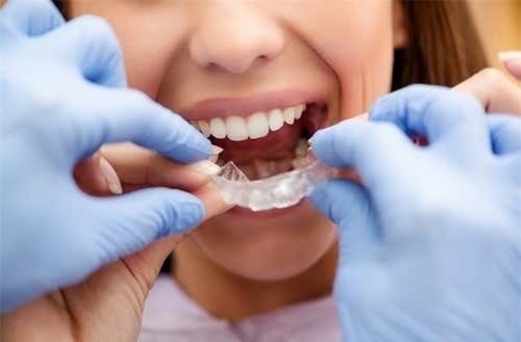 คอร์สจัดฟันแบบใส Invisalign Lite ฟันบนและล่าง ที่ Bangkok Smile Dental