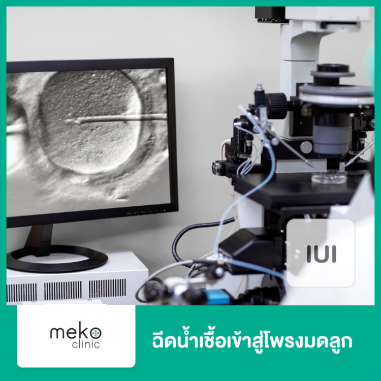 ฉีดน้ำเชื้อเข้าสู่โพรงมดลูก (IUI) ที่ Meko IVF (เมโกะ ไอวีเอฟ)Meko Clinic (เมโกะ คลินิก)