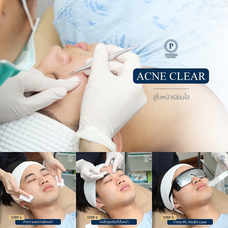 รักษาสิว 4 ขั้นตอน (Acne Clear) 1 ครั้ง ที่ Punnisa Clinic (ปันนิสาคลินิก)
