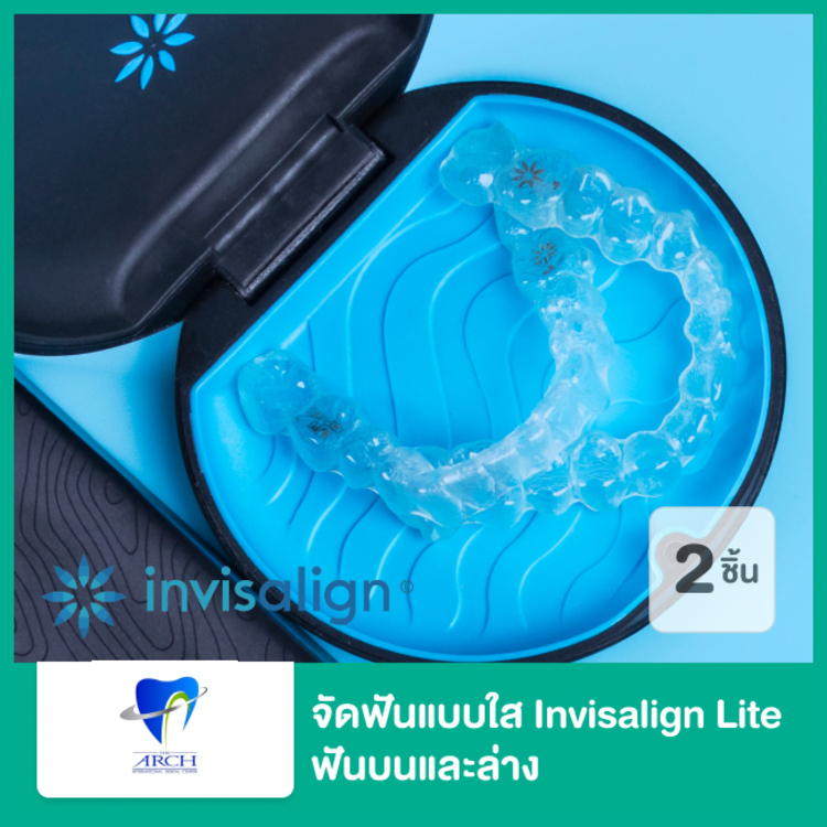 จัดฟันแบบใส Invisalign Lite ฟันบนและล่าง ที่ The ARCH Dental Center (ศูนย์ทันตกรรมดิอาร์ช)