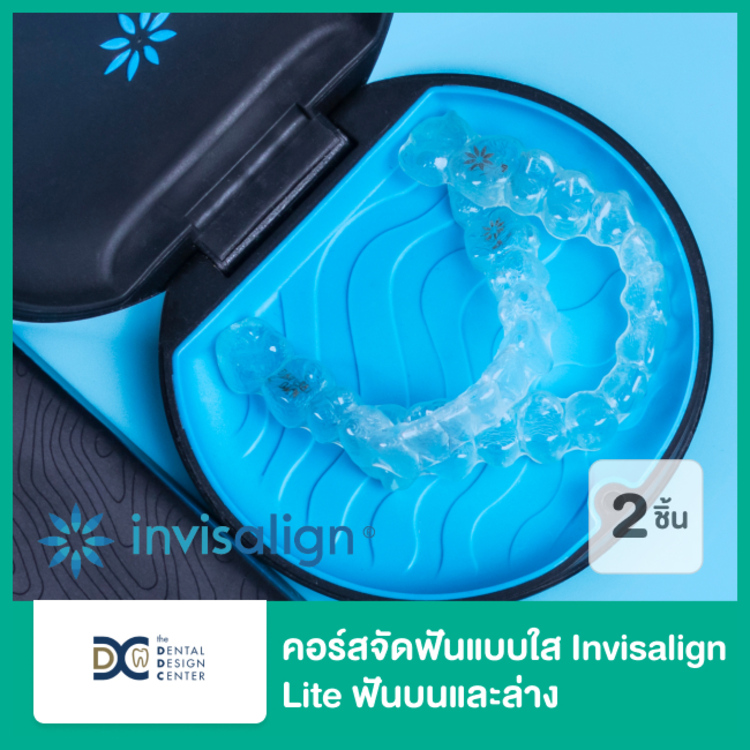 คอร์สจัดฟันแบบใส Invisalign Lite ฟันบนและล่าง ที่ Dental Design Center