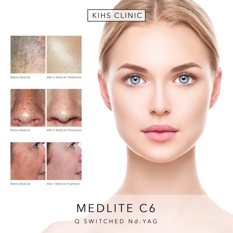 เลเซอร์หน้า ด้วยเทคโนโลยี MedLite C6 1 ครั้ง ที่ KIHS Clinic