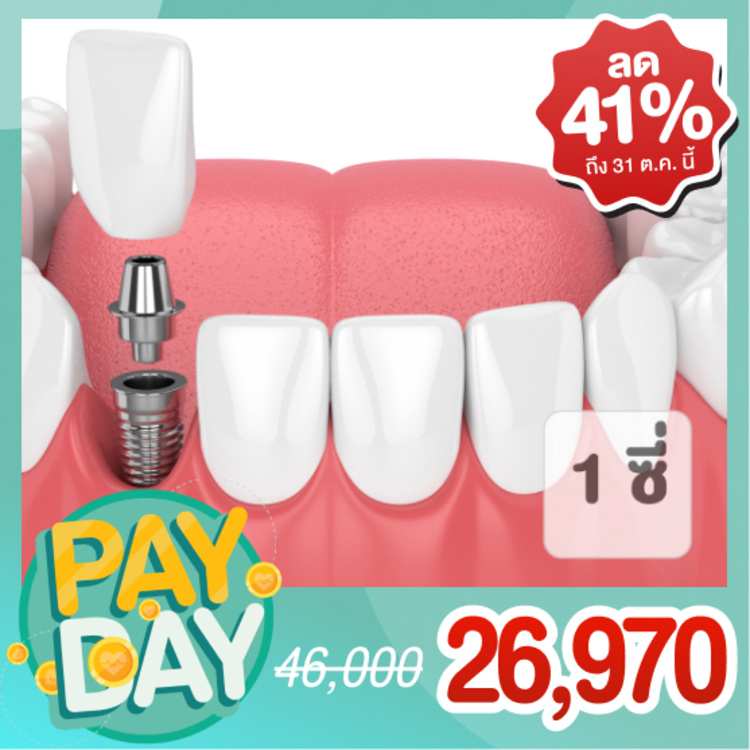 ทำรากฟันเทียม รวมครอบฟัน PFM 1 ซี่ ที่ Zenitoni Dental Clinic