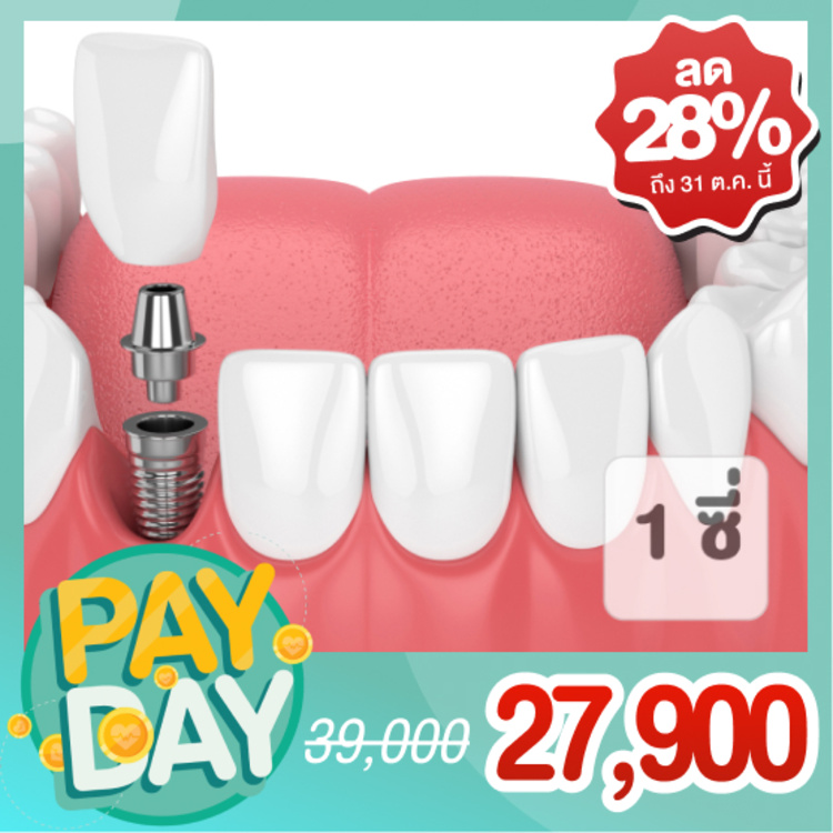 ทำรากฟันเทียม ยี่ห้อ Thai Implant รวมครอบฟัน 1 ซี่ ที่ Bangkok Grand Dental