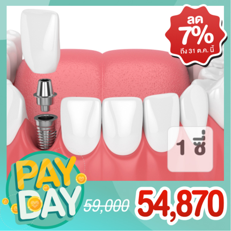ทำรากฟันเทียม ยี่ห้อ Osstem หรือ Neobiotech พร้อมครอบฟัน 1 ซี่ (ตามแพทย์ประเมิน) ที่ Teeth Solution Clinic