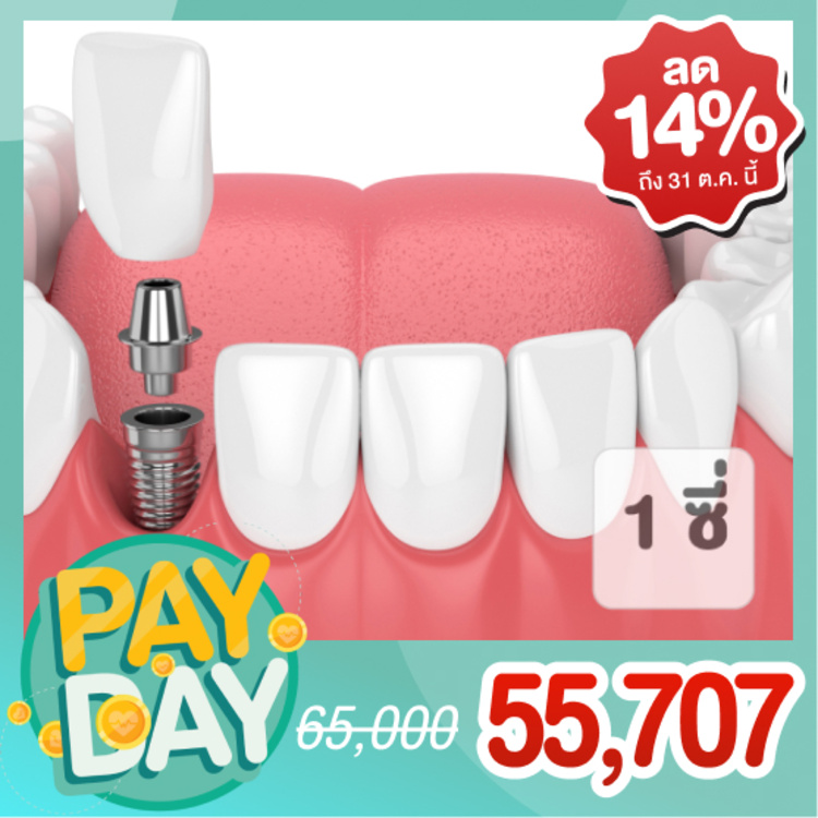 ทำรากฟันเทียมยี่ห้อ Straumann รวมครอบฟัน 1 ซี่ ที่ Iconic Dental Clinic