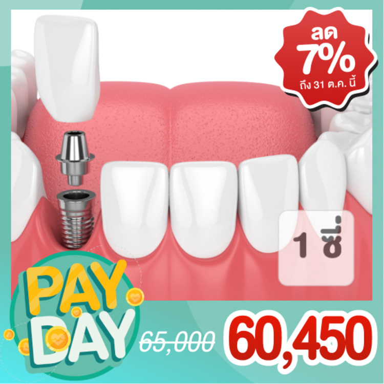 ทำรากฟันเทียม ยี่ห้อ SIC รวมครอบฟัน 1 ซี่ ที่ ออร์โธ สไมล์ ออร์โธ สไมล์
