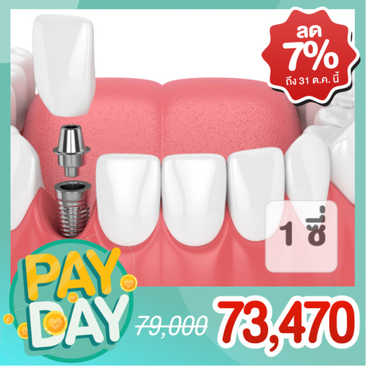 ทำรากฟันเทียม ยี่ห้อ Straumann พร้อมครอบฟัน 1 ซี่ (ตามแพทย์ประเมิน) ที่ Teeth Solution Clinic