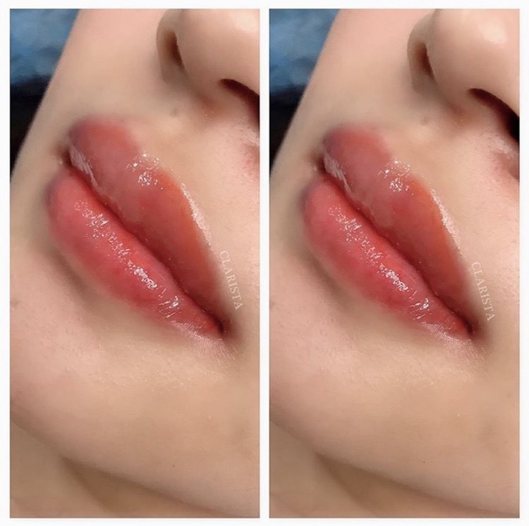 ฝังสีปาก 1 ครั้ง ที่ Clarista Organic Aesthetic Salon