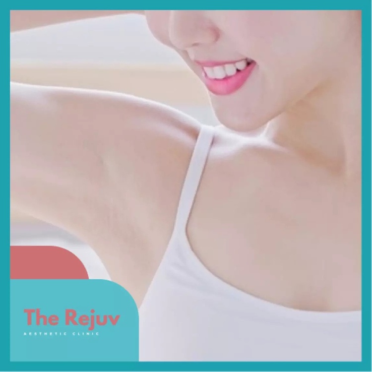 เลเซอร์ผิวหนังไก่ ด้วยเครื่อง E-Max 1 ครั้ง ที่ The Rejuv Clinic