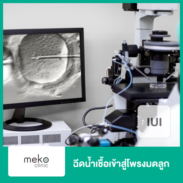 ฉีดน้ำเชื้อเข้าสู่โพรงมดลูก (IUI) ที่ Beyond IVF by Meko