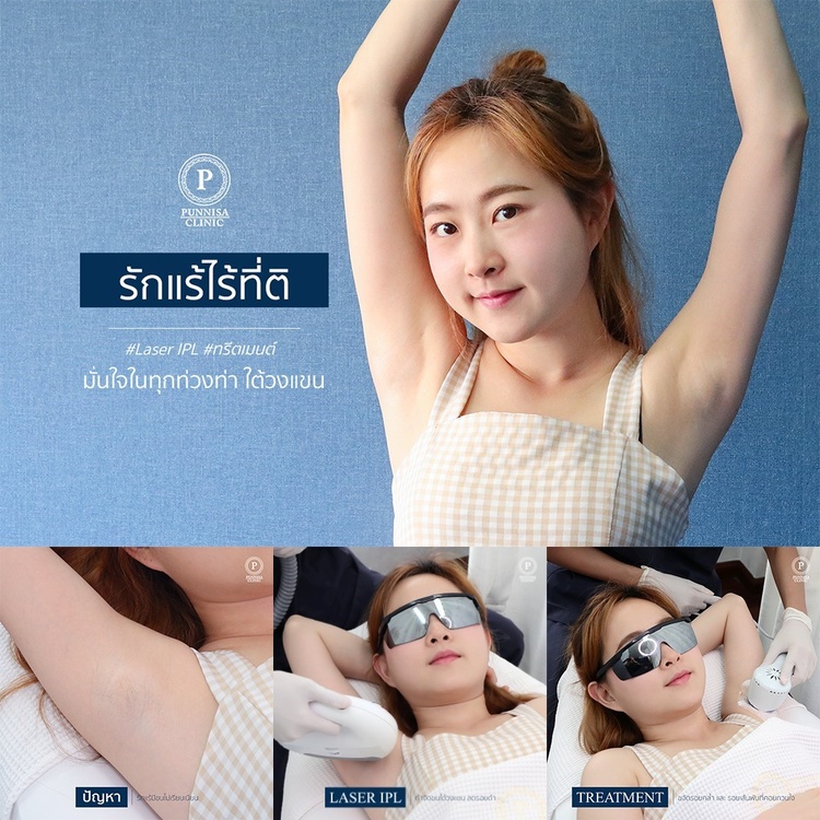 กำจัดขนรักแร้ด้วย IPL 1 ครั้ง ที่ Punnisa Clinic (ปันนิสาคลินิก)