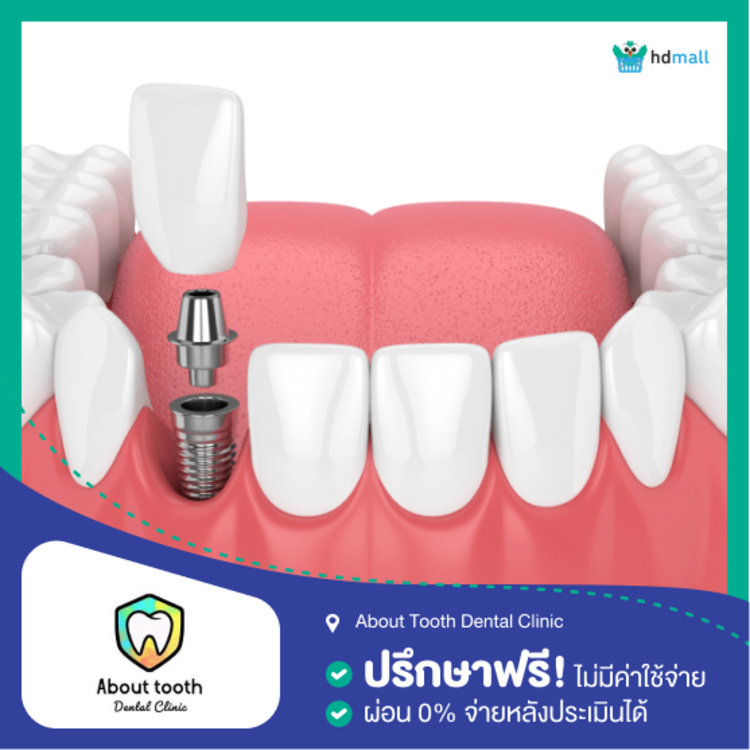 ทำรากฟันเทียมและครอบฟัน ที่ About Tooth Dental Clinic